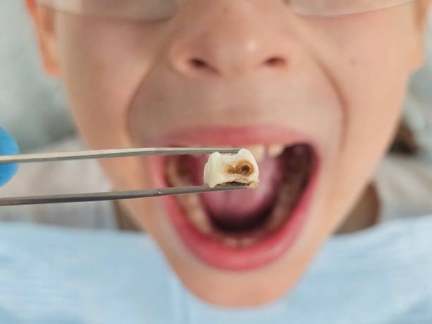 Best Emergency Tooth Extraction in St Joseph, IL